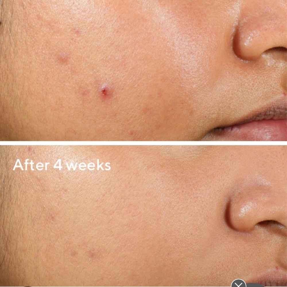 New! Murad Clarifying Water Gel For Acne